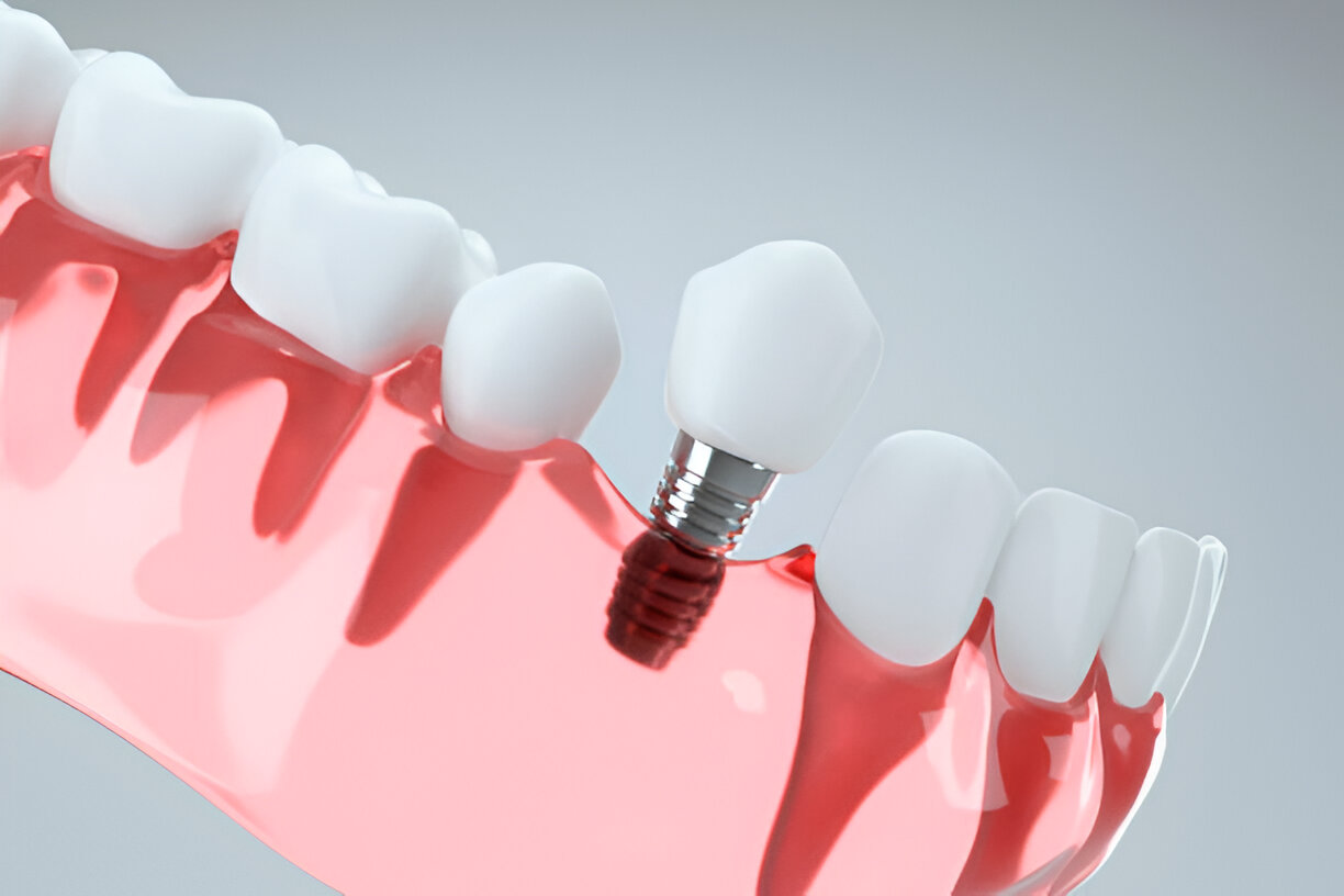 dental implants keller tx Archives Encore Dental Keller Family Dental