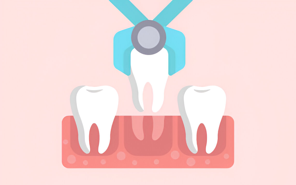 Keller Family Dental’s Approach to Tooth Extractions in Keller, TX_FI