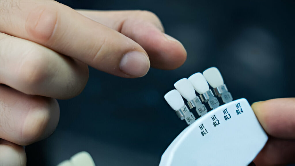 Best Dentists in Keller, TX for Dental Veneers – What to Expect at Keller Family Dental_2