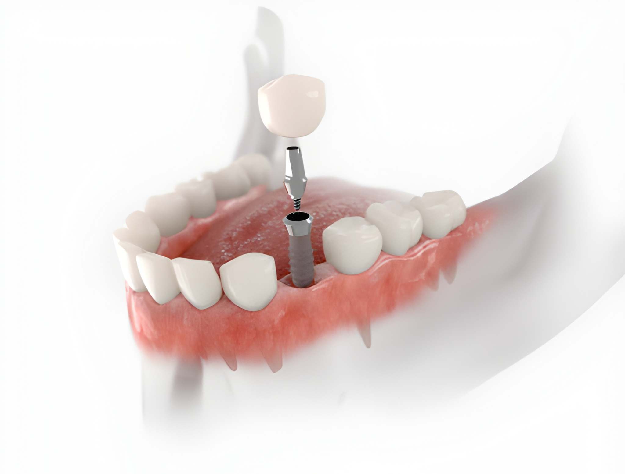 Are Dental Implants Right for You? Keller, TX Dentist Explains the Benefits_FI