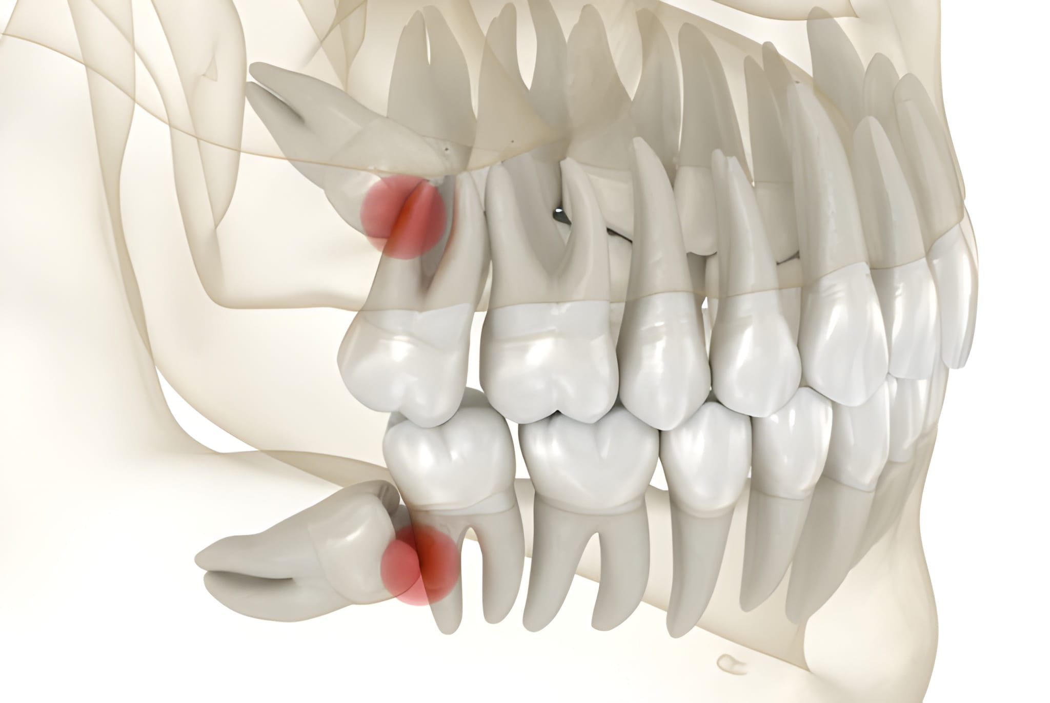 How to Prepare for Wisdom Tooth Surgery - Tips from Keller Family Dental_FI